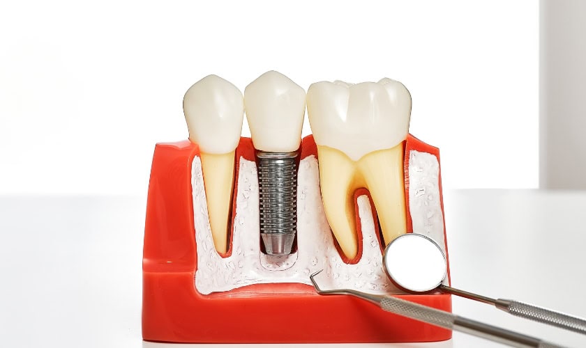 prepare for your dental implant appointment