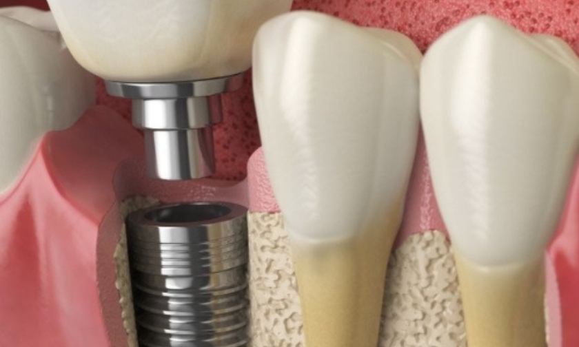dental implants seattle