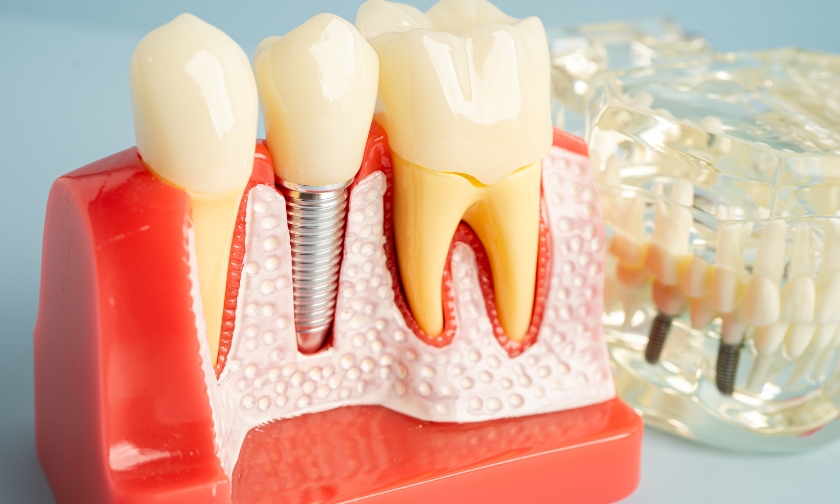maintain a healthy oral microbiome for dental implants