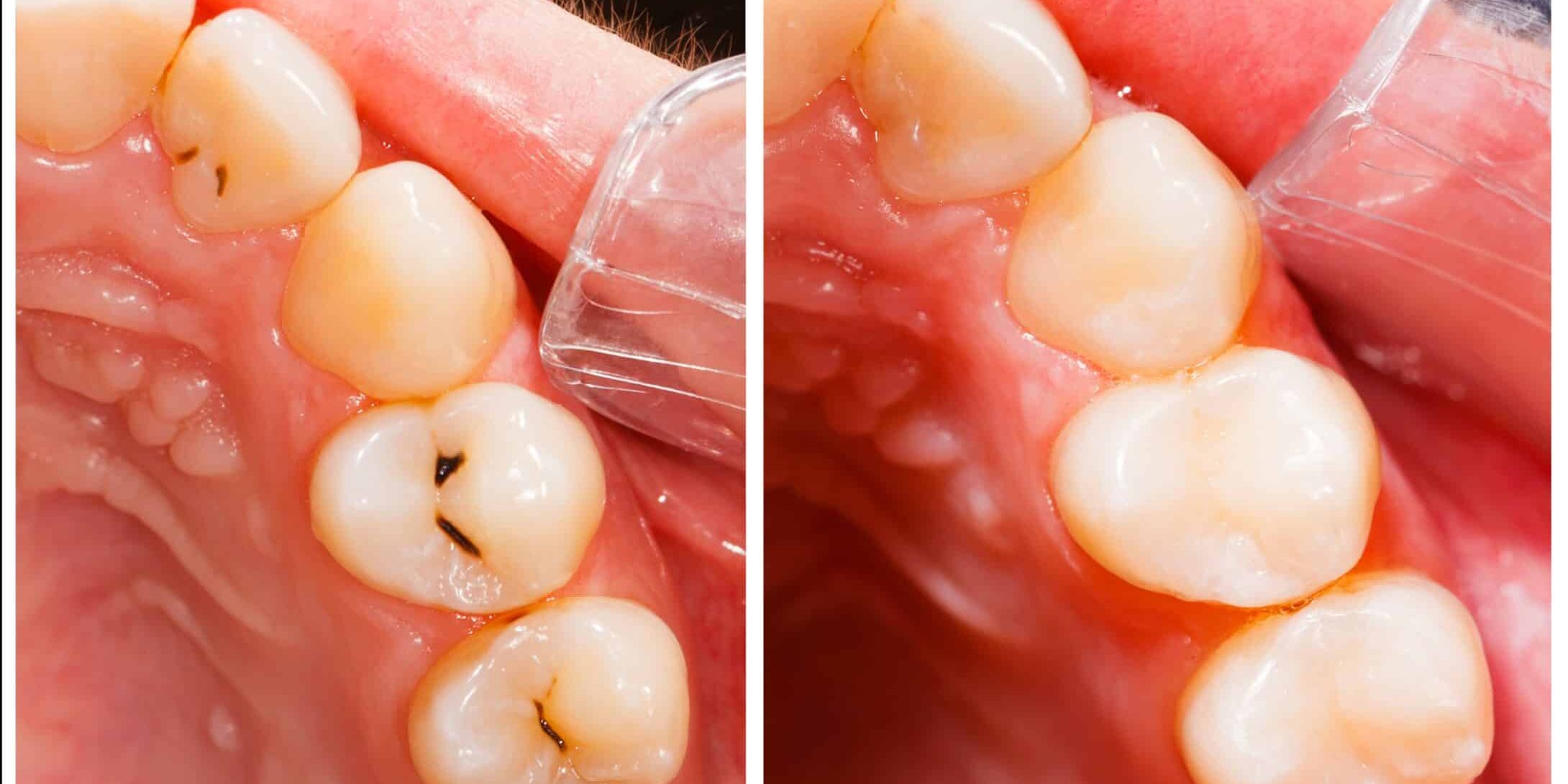 Teeth before and after treatment - dental composite filling.