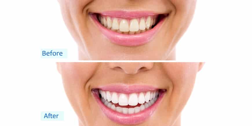 Teeth Whitening Coffee Stains